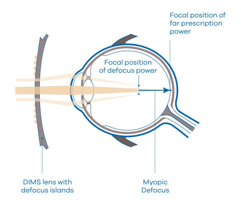 Myopia - image MiYOSMART-img on https://www.eyeconnection.com.au