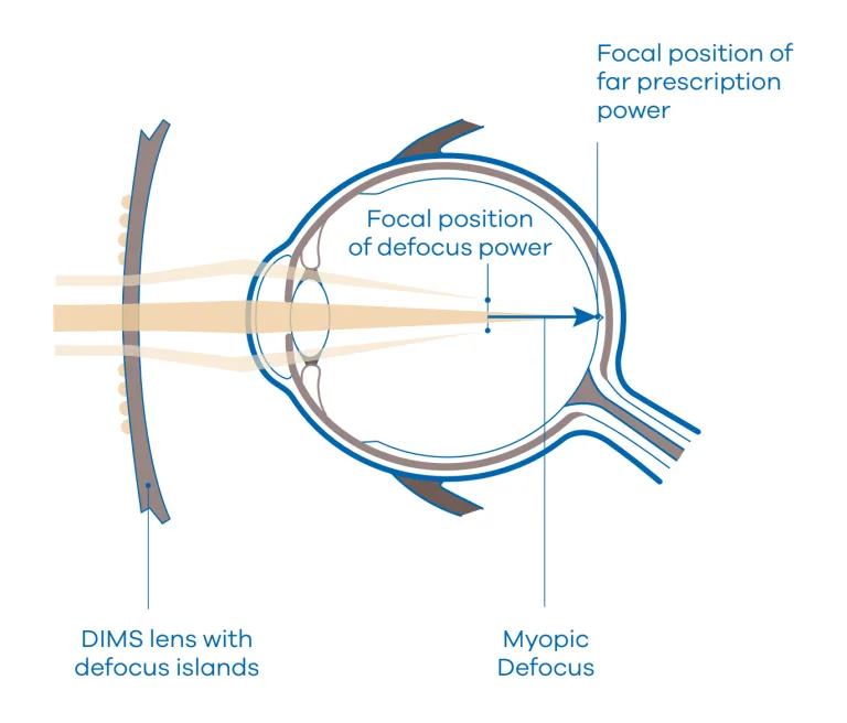 Myopia - image MiYOSMART-img on https://www.eyeconnection.com.au
